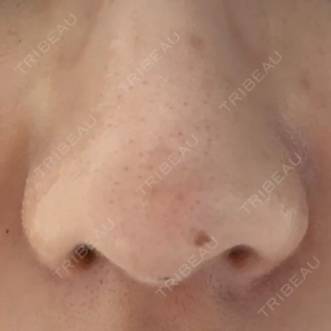 鼻孔縁挙上 シエルクリニック BEFORE メイン用