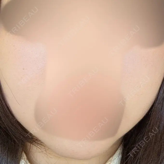 糸リフト / 脂肪吸引（顔） 東京ココセランクリニック BEFORE メイン用