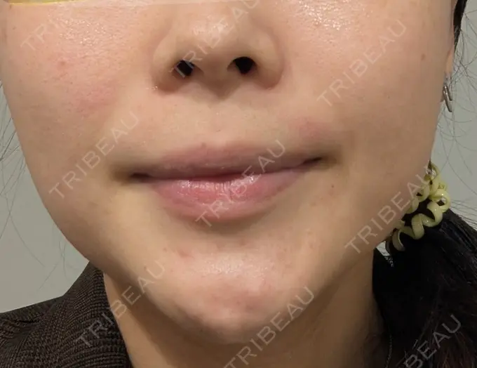 ルメッカ 大美会クリニック 神戸院 BEFORE メイン用