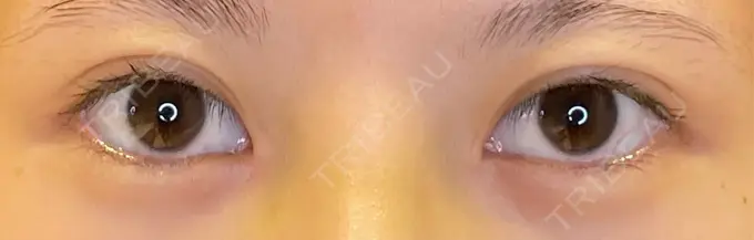 目尻切開 / タレ目形成・グラマラスライン（埋没） LOUIS CLINIC 二子玉川院【ルイクリニック】 BEFORE メイン用