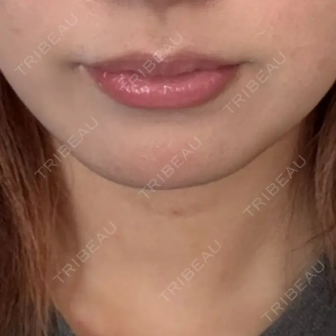 ボトックス（エラ・小顔） / ボトックス（首） DMTC CLINIC 渋谷院 BEFORE メイン用