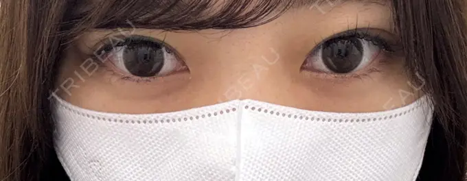 ヒアルロン酸注入（涙袋） フィラークリニック 名古屋栄院 BEFORE メイン用