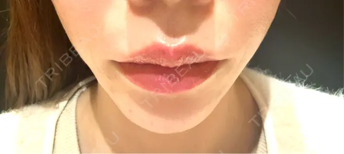 人中短縮 / 口角挙上 R Beauty CLINIC 銀座院 BEFORE メイン用