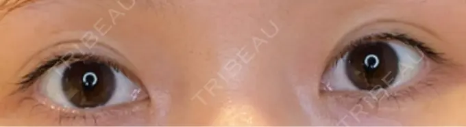 目尻切開 / タレ目形成・グラマラスライン（埋没） LOUIS CLINIC 二子玉川院【ルイクリニック】 BEFORE メイン用