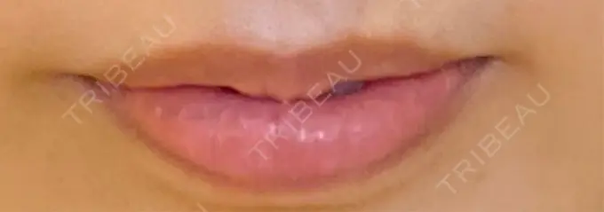 ヒアルロン酸注入（唇） / ヒアルロン酸注入（額） 目白ホワイトクリニック BEFORE メイン用