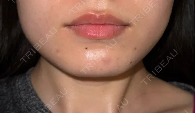 ボトックス（エラ・小顔） TCB東京中央美容外科 大阪阪急梅田駅前院 BEFORE メイン用