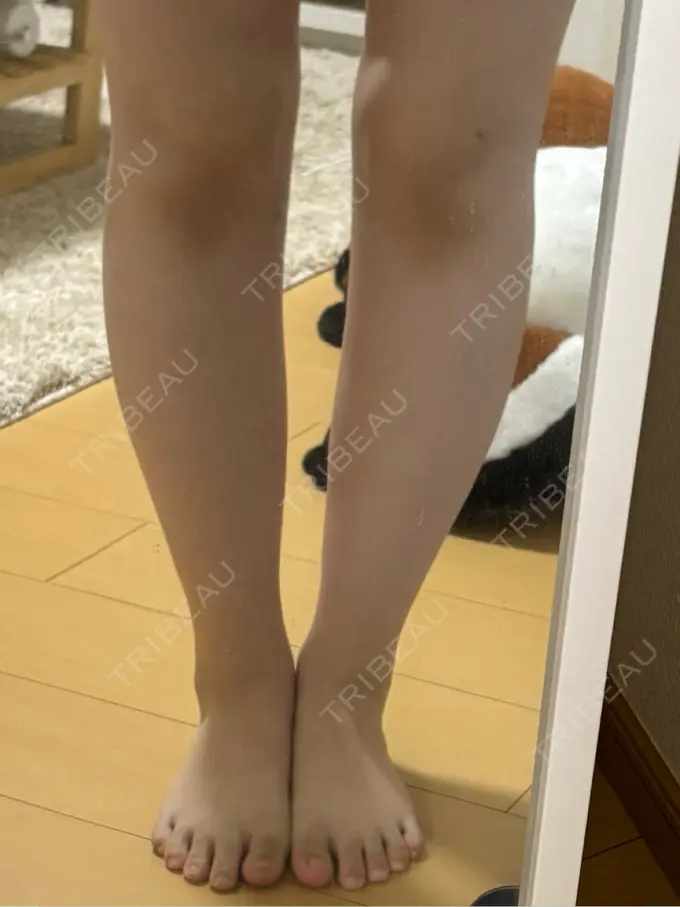 脂肪吸引（脚） / ボトックス（ふくらはぎ） Mods Clinic（モッズクリニック） 名古屋院 BEFORE メイン用