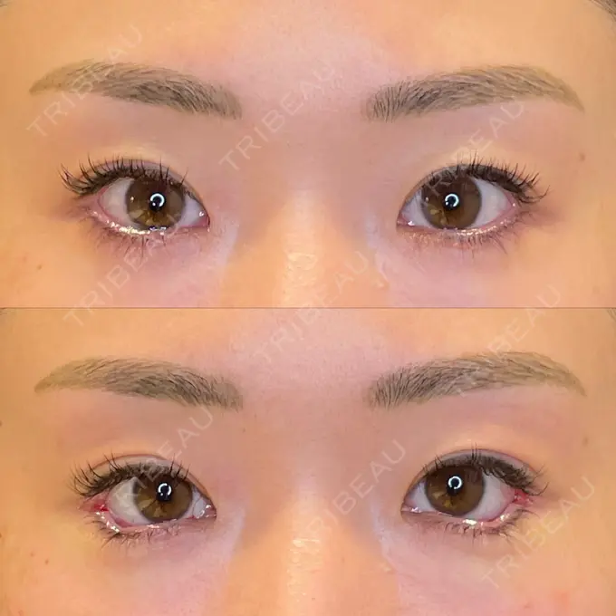 目尻切開 / タレ目形成・グラマラスライン（埋没） LOUIS CLINIC 二子玉川院【ルイクリニック】 BEFORE メイン用
