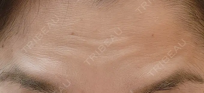 ボトックス（眉間） / ボトックス（目尻） / ボトックス（額） DMTC美容皮膚科 大宮院 BEFORE メイン用