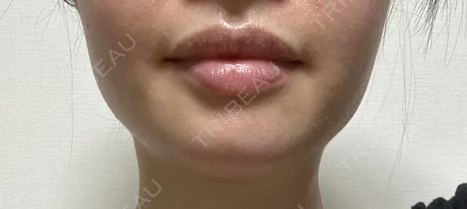 ボトックス（エラ・小顔） TCB東京中央美容外科 自由が丘院 BEFORE メイン用