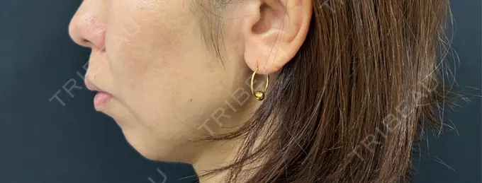 ボトックス（あご） / ヒアルロン酸注入（あご） / ヒアルロン酸注入（頬） HAAB BEAUTY CLINIC 名古屋院 BEFORE メイン用