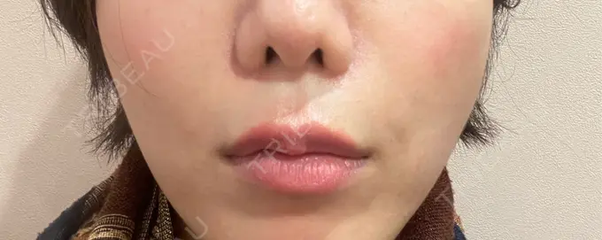 ヒアルロン酸溶解 EOL CLINIC【オルクリニック】 BEFORE メイン用