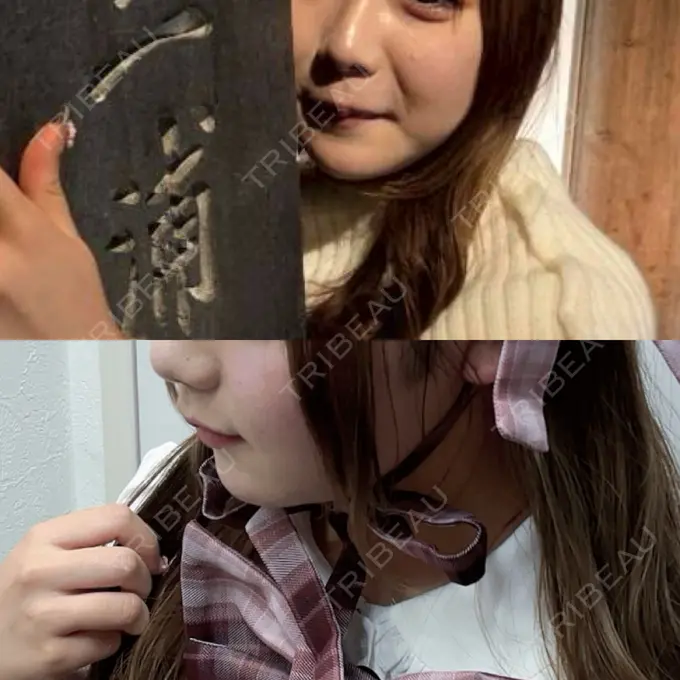 ボトックス（エラ・小顔） / インモード ルラ美容クリニック 町田院 BEFORE メイン用