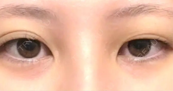 自然癒着法 eクリニック 福岡院 BEFORE メイン用