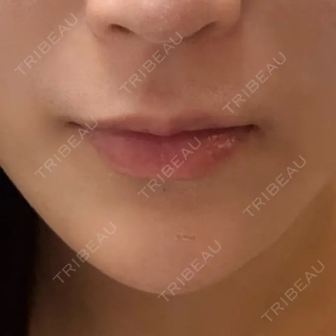 ヒアルロン酸注入（唇） 目白ホワイトクリニック BEFORE メイン用