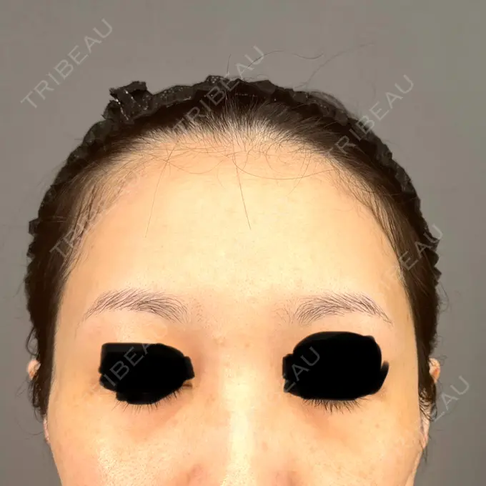 クマ治療 / 脂肪注入（額） / 脂肪吸引（腰） Casa de GRACIA GINZA 【カーサデグラシアギンザ】 BEFORE メイン用