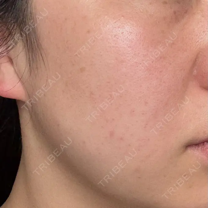 イオン導入 / 毛穴洗浄（ハイドラフェイシャルなど） / ルメッカ ルラ美容クリニック 仙台院 / ルラスキンクリニック 仙台院 BEFORE メイン用