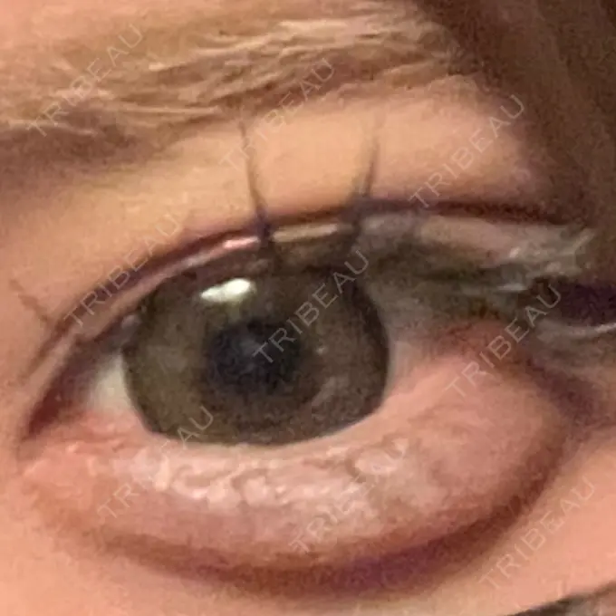 ボトックス（エラ・小顔） TCB東京中央美容外科 浜松院 BEFORE メイン用