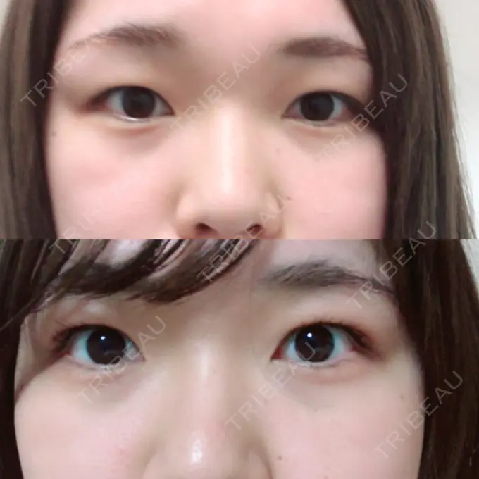 二重埋没 新宿美容外科クリニック 立川院 BEFORE メイン用