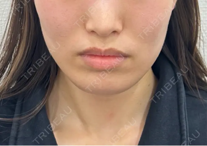 糸リフト / ヒアルロン酸注入（頬） 東京シンデレラ美容外科 池袋院 BEFORE メイン用