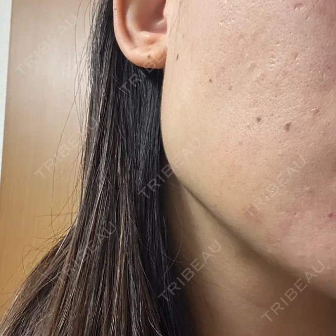 ボトックス（エラ・小顔） フィラークリニック 名古屋栄院 BEFORE メイン用