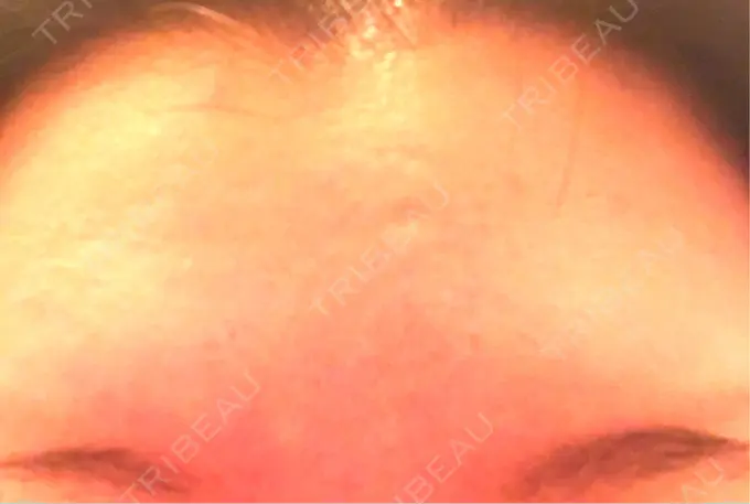 ボトックス（額） 湘南美容クリニック 名古屋栄院 BEFORE メイン用