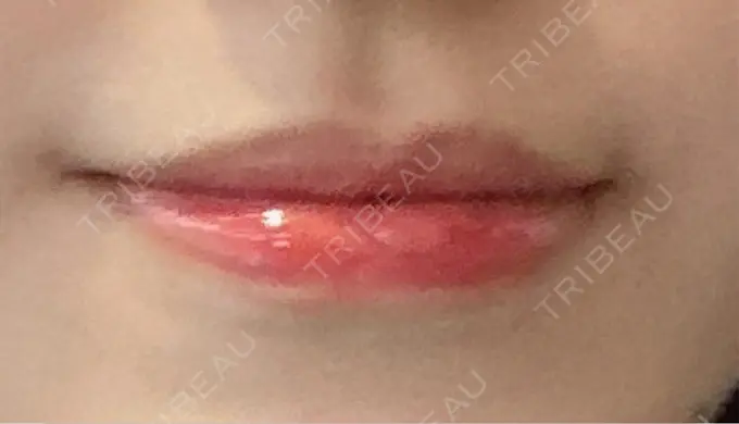 ヒアルロン酸注入（涙袋） / ヒアルロン酸注入（唇） アリエル美容クリニック 横浜院 BEFORE メイン用