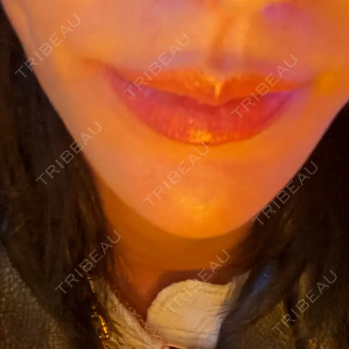 ハイフ（顔） クレオビューティークリニック BEFORE メイン用