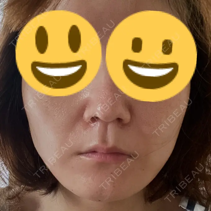 糸リフト SK新宿歌舞伎町美容外科・歯科 BEFORE メイン用