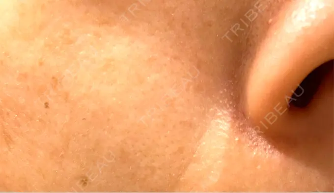 エレクトロポレーション / ピーリング（ハリ・ツヤ） ルラ美容クリニック 仙台院 / ルラスキンクリニック 仙台院 BEFORE メイン用