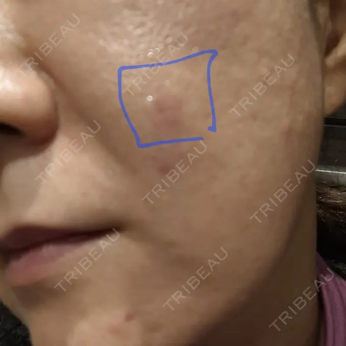 ボトックス（額） / ピコスポット 東京ココセランクリニック BEFORE メイン用