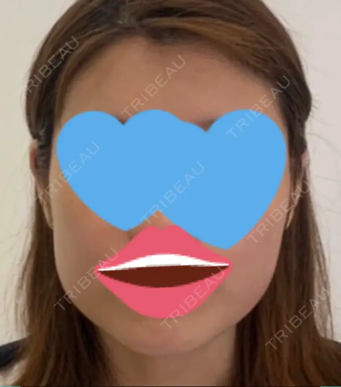 ボトックス（エラ・小顔） 赤坂プレミアクリニック BEFORE メイン用