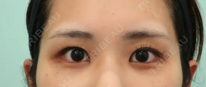 二重埋没 WOM CLINIC GINZA （ワム クリニック ギンザ） BEFORE メイン用