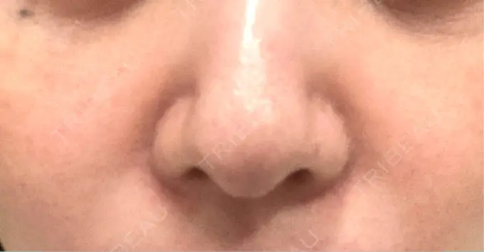 ヒアルロン酸注入（目の下） / ヒアルロン酸注入（鼻翼基部） 湘南美容クリニック 博多院 BEFORE メイン用