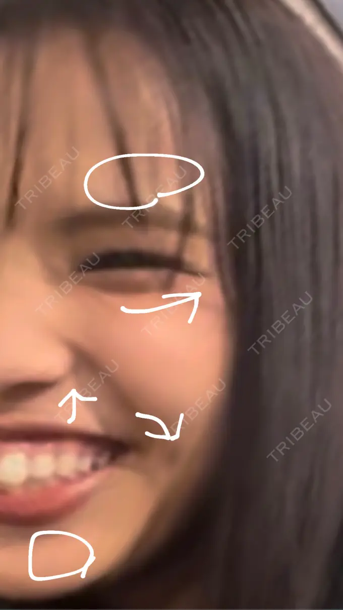 ボトックス（あご） / ボトックス（口角） / ボトックス（タレ目） / ボトックス（眉間） / ボトックス（ガミースマイル） 神戸スイミー皮膚科美容外科 BEFORE メイン用