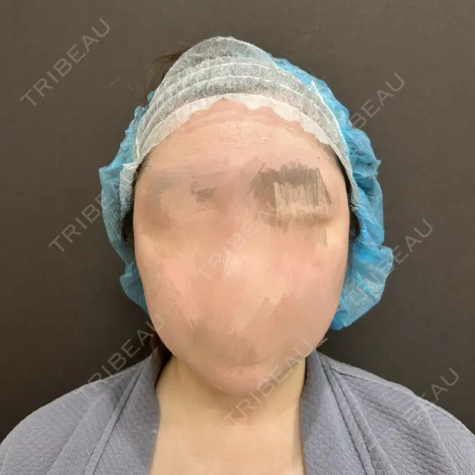 糸リフト / 脂肪吸引（顔） 東京ココセランクリニック BEFORE メイン用