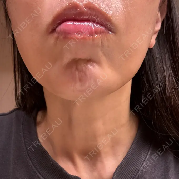 ボトックス（あご） DMTC美容皮膚科 大宮院 BEFORE メイン用