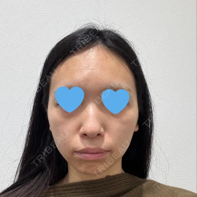 ピーリング（ニキビ・毛穴） / イオン導入 First Clinic BEFORE メイン用