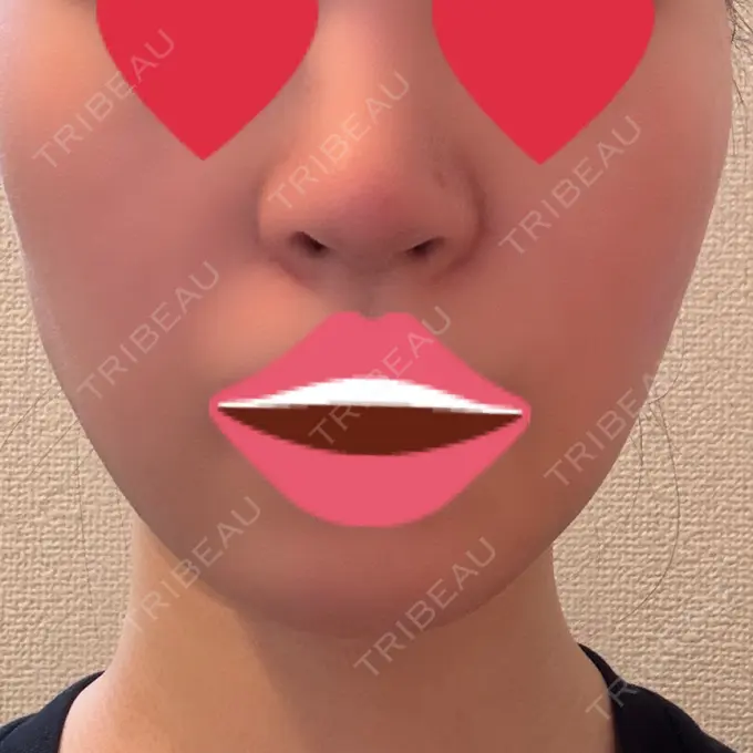 ボトックス（エラ・小顔） / ハイフ（顔） LOUIS CLINIC 二子玉川院【ルイクリニック】 BEFORE メイン用