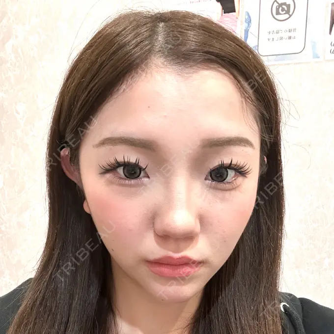 クマ治療 / 脂肪吸引（顔） / ヒアルロン酸注入（涙袋） / ヒアルロン酸注入（目の下） ネビュラクリニック 東京錦糸町院 BEFORE メイン用