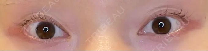 目尻切開 / タレ目形成・グラマラスライン（埋没） LOUIS CLINIC 二子玉川院【ルイクリニック】 BEFORE メイン用