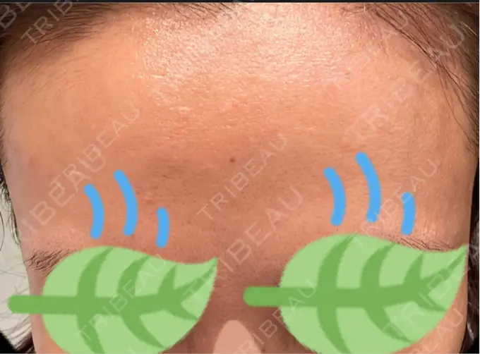 その他（肌） / エレクトロポレーション 品川美容外科 心斎橋院 BEFORE メイン用