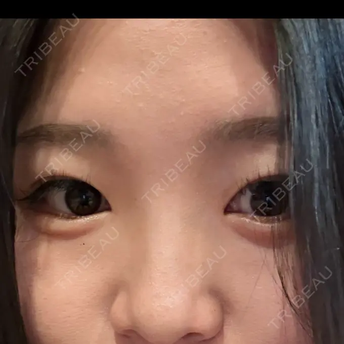 ヒアルロン酸注入（涙袋） ルラ美容クリニック 大宮院 / ルラスキンクリニック 大宮院 BEFORE メイン用