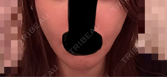 デンシティ 城本クリニック 新宿院 BEFORE メイン用