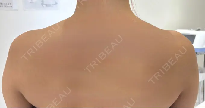 ボトックス（肩） / ワキ汗治療（ボトックス） DMTC CLINIC 渋谷院 BEFORE メイン用