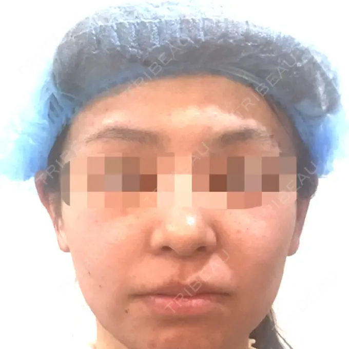 その他（目元） 青山セレスクリニック 青山院 BEFORE メイン用