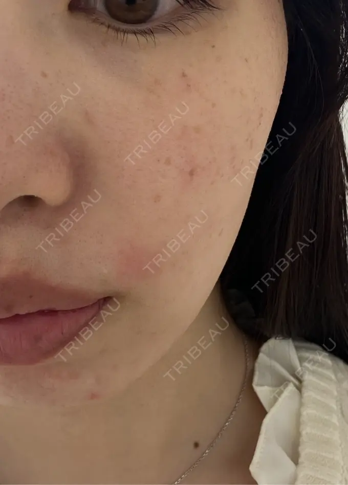 ルメッカ ルラ美容クリニック 千葉院 / ルラスキンクリニック 千葉院 BEFORE メイン用