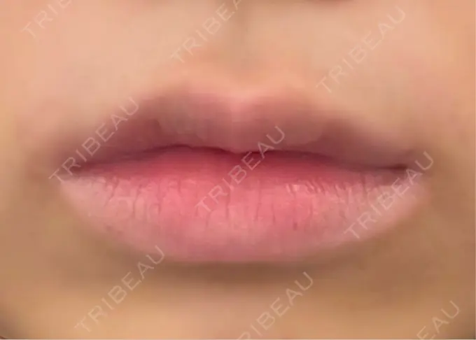 ヒアルロン酸注入（唇） / ボトックス（口角） ルラ美容クリニック 大阪心斎橋院 BEFORE メイン用