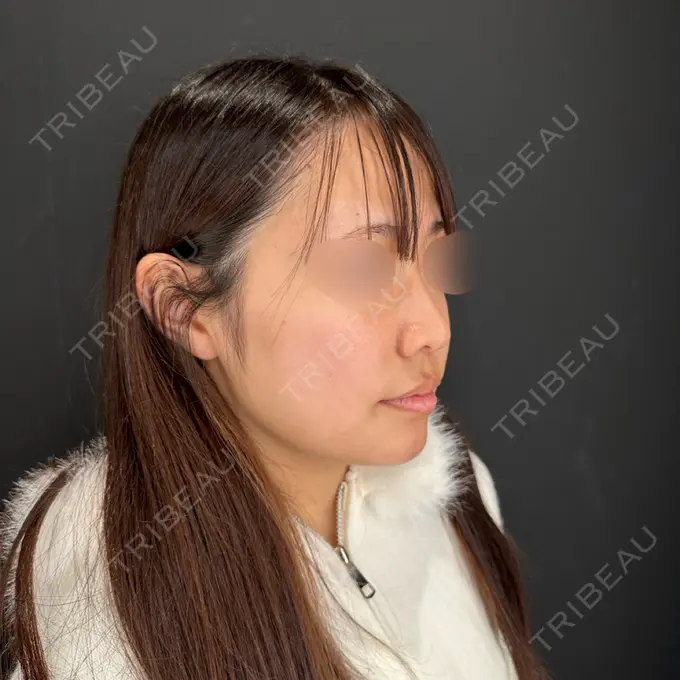 ヒアルロン酸注入（涙袋） / ヒアルロン酸注入（鼻） / ボトックス（あご） / ボトックス（エラ・小顔） HAAB×DREAM BEAUTY CLINIC 大阪梅田院 BEFORE メイン用