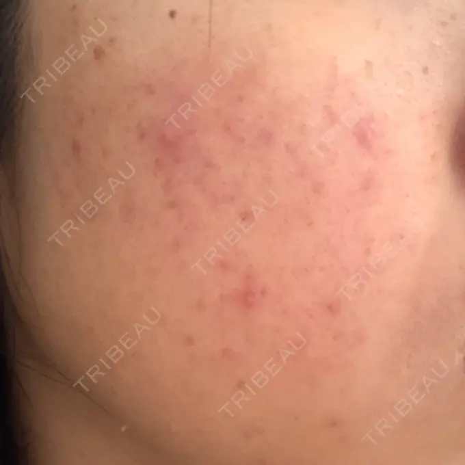 イオン導入 / 毛穴洗浄（ハイドラフェイシャルなど） / ルメッカ 東京シルククリニック 東京神田院 BEFORE メイン用